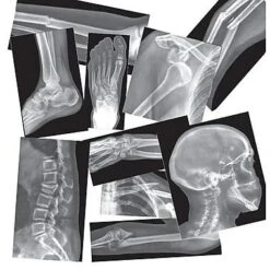 Broken Bones X Ray